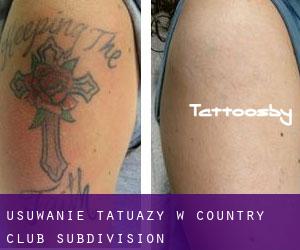 Usuwanie tatuaży w Country Club Subdivision