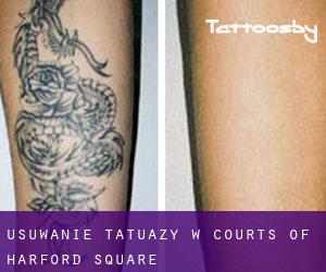 Usuwanie tatuaży w Courts of Harford Square