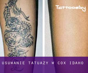 Usuwanie tatuaży w Cox (Idaho)