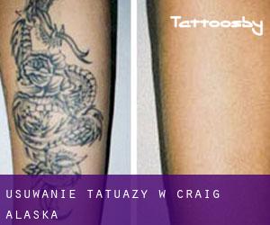 Usuwanie tatuaży w Craig (Alaska)
