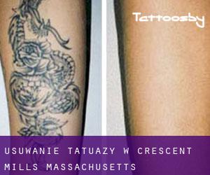 Usuwanie tatuaży w Crescent Mills (Massachusetts)