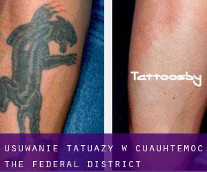 Usuwanie tatuaży w Cuauhtémoc (The Federal District)
