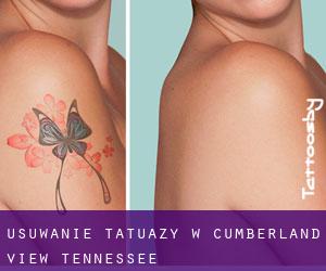 Usuwanie tatuaży w Cumberland View (Tennessee)