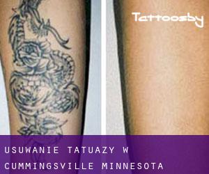 Usuwanie tatuaży w Cummingsville (Minnesota)