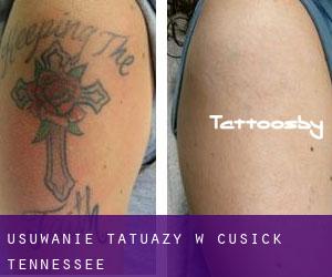 Usuwanie tatuaży w Cusick (Tennessee)