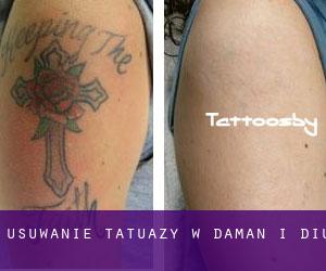 Usuwanie tatuaży w Daman i Diu