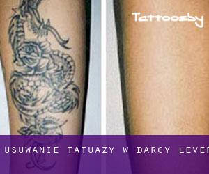 Usuwanie tatuaży w Darcy Lever