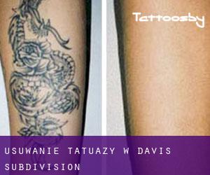 Usuwanie tatuaży w Davis Subdivision