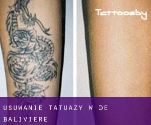 Usuwanie tatuaży w De Baliviere