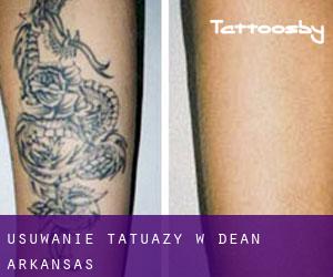 Usuwanie tatuaży w Dean (Arkansas)