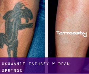 Usuwanie tatuaży w Dean Springs