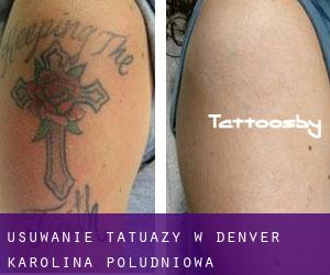 Usuwanie tatuaży w Denver (Karolina Południowa)