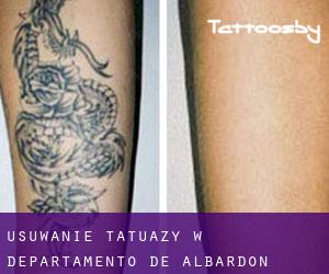 Usuwanie tatuaży w Departamento de Albardón