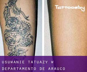 Usuwanie tatuaży w Departamento de Arauco