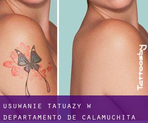 Usuwanie tatuaży w Departamento de Calamuchita