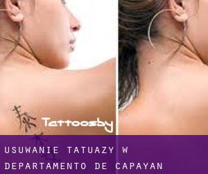 Usuwanie tatuaży w Departamento de Capayán