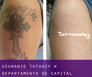Usuwanie tatuaży w Departamento de Capital
