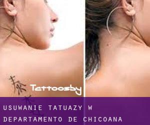 Usuwanie tatuaży w Departamento de Chicoana