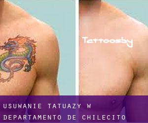 Usuwanie tatuaży w Departamento de Chilecito