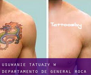 Usuwanie tatuaży w Departamento de General Roca