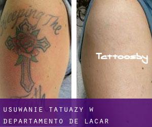 Usuwanie tatuaży w Departamento de Lácar