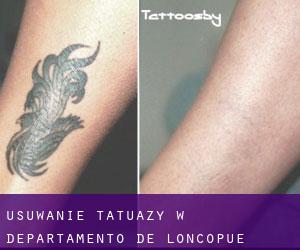 Usuwanie tatuaży w Departamento de Loncopué