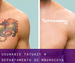 Usuwanie tatuaży w Departamento de Mburucuyá