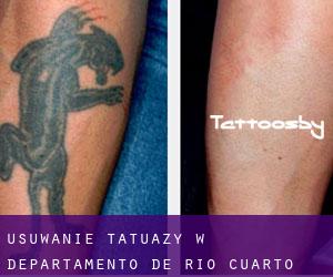 Usuwanie tatuaży w Departamento de Río Cuarto