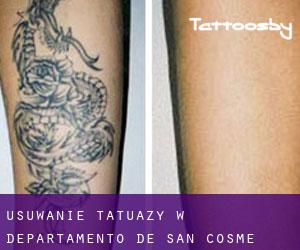Usuwanie tatuaży w Departamento de San Cosme
