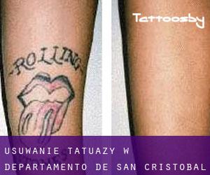 Usuwanie tatuaży w Departamento de San Cristóbal