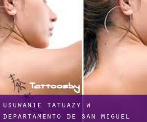 Usuwanie tatuaży w Departamento de San Miguel