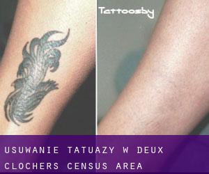 Usuwanie tatuaży w Deux-Clochers (census area)