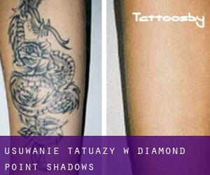 Usuwanie tatuaży w Diamond Point Shadows
