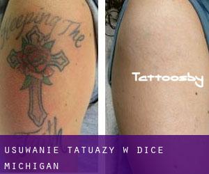Usuwanie tatuaży w Dice (Michigan)