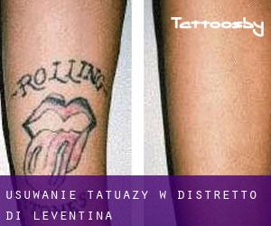 Usuwanie tatuaży w Distretto di Leventina