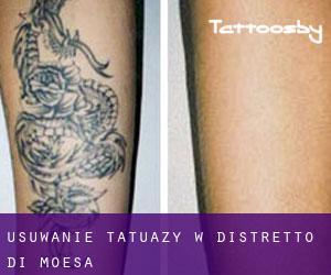 Usuwanie tatuaży w Distretto di Moesa