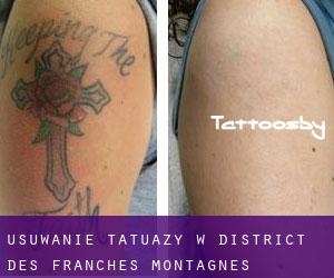 Usuwanie tatuaży w District des Franches-Montagnes