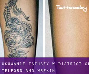 Usuwanie tatuaży w District of Telford and Wrekin