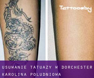 Usuwanie tatuaży w Dorchester (Karolina Południowa)