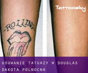 Usuwanie tatuaży w Douglas (Dakota Północna)