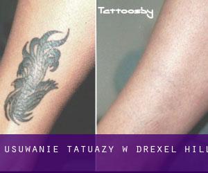 Usuwanie tatuaży w Drexel Hill