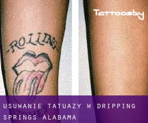 Usuwanie tatuaży w Dripping Springs (Alabama)