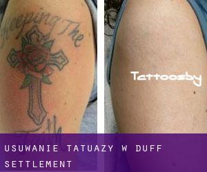 Usuwanie tatuaży w Duff Settlement