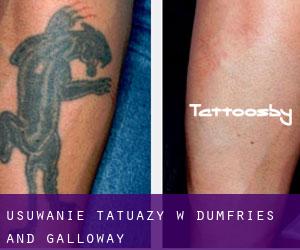 Usuwanie tatuaży w Dumfries and Galloway