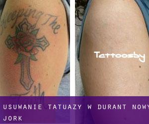 Usuwanie tatuaży w Durant (Nowy Jork)