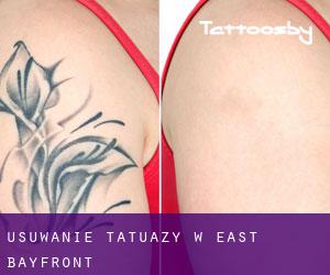 Usuwanie tatuaży w East Bayfront