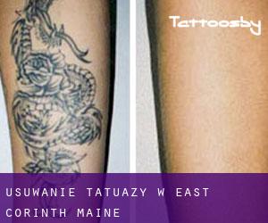 Usuwanie tatuaży w East Corinth (Maine)