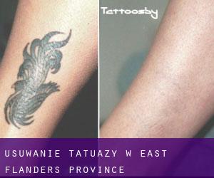 Usuwanie tatuaży w East Flanders Province