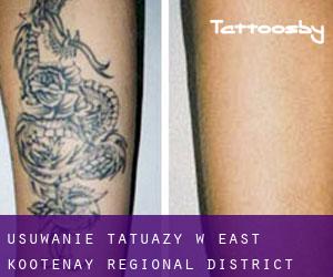 Usuwanie tatuaży w East Kootenay Regional District