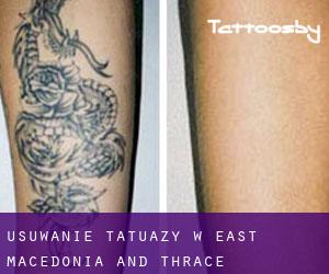 Usuwanie tatuaży w East Macedonia and Thrace